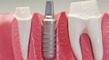 Dental Implants Las Vegas