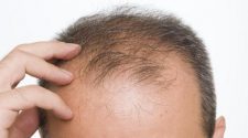 How Does Hair Loss Surgery Work?