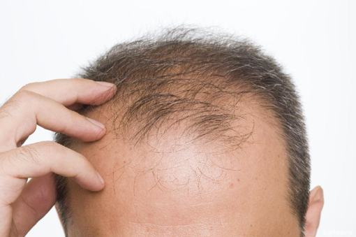 How Does Hair Loss Surgery Work?
