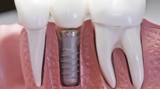 dental implants Dublin