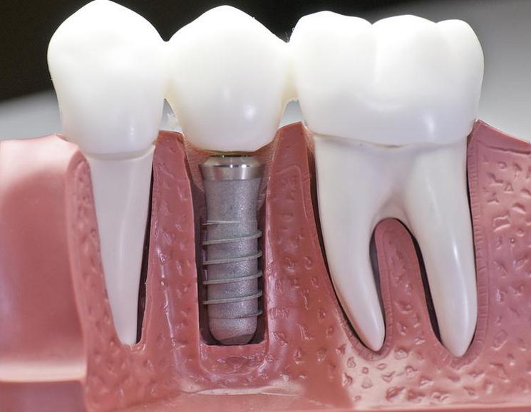 dental implants Dublin