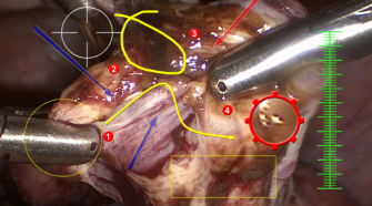 medical video capture device