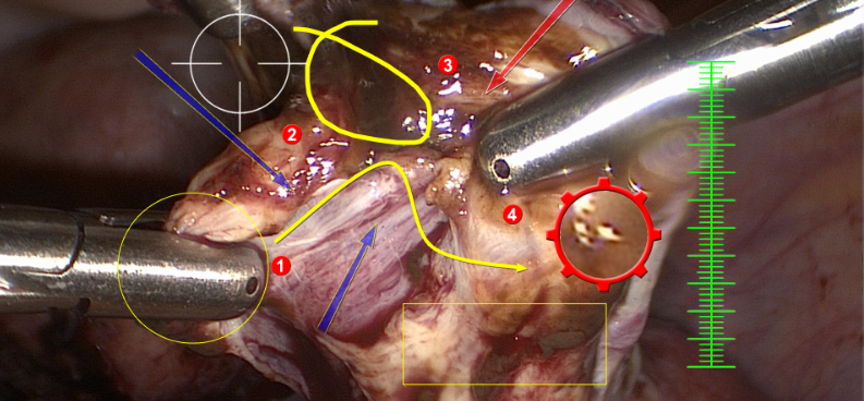 medical video capture device