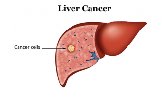 Liver Cancer - A Condition Of The Liver Cells, That May Prove Fatal At Its Advance Stage