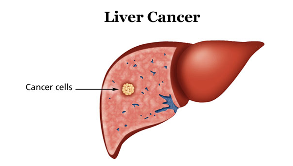 Liver Cancer - A Condition Of The Liver Cells, That May Prove Fatal At Its Advance Stage