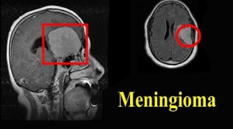 Meningioma