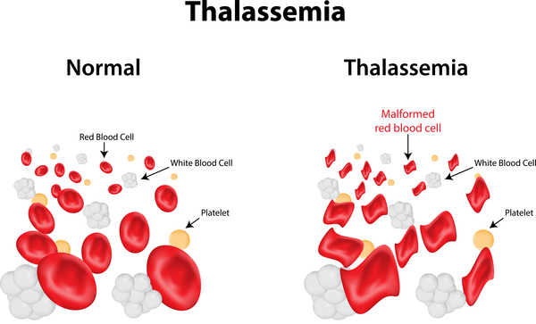 Types Of Thalassemia and Their Causes